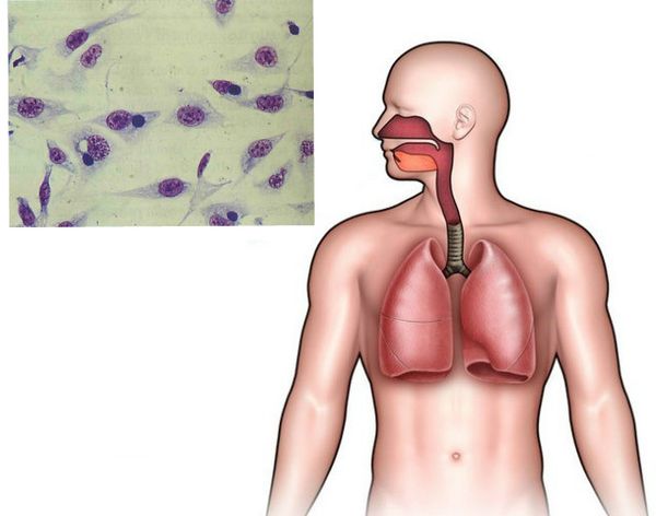 Пневмония вызванная хламидиями