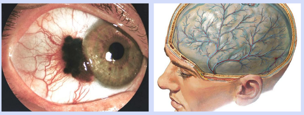 Цистицеркоз мозга и глаза 