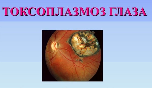 Глазная форма токсоплазмоза