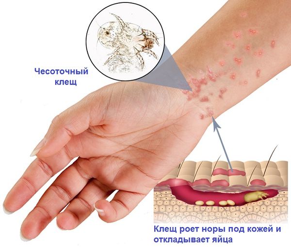 Patient information: Scabies (Beyond the Basics) - UpToDate